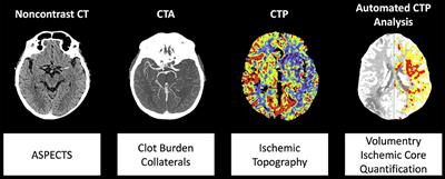 Decomposing Acute Symptom Severity in Large Vessel Occlusion Stroke: Association With Multiparametric CT Imaging and Clinical Parameters